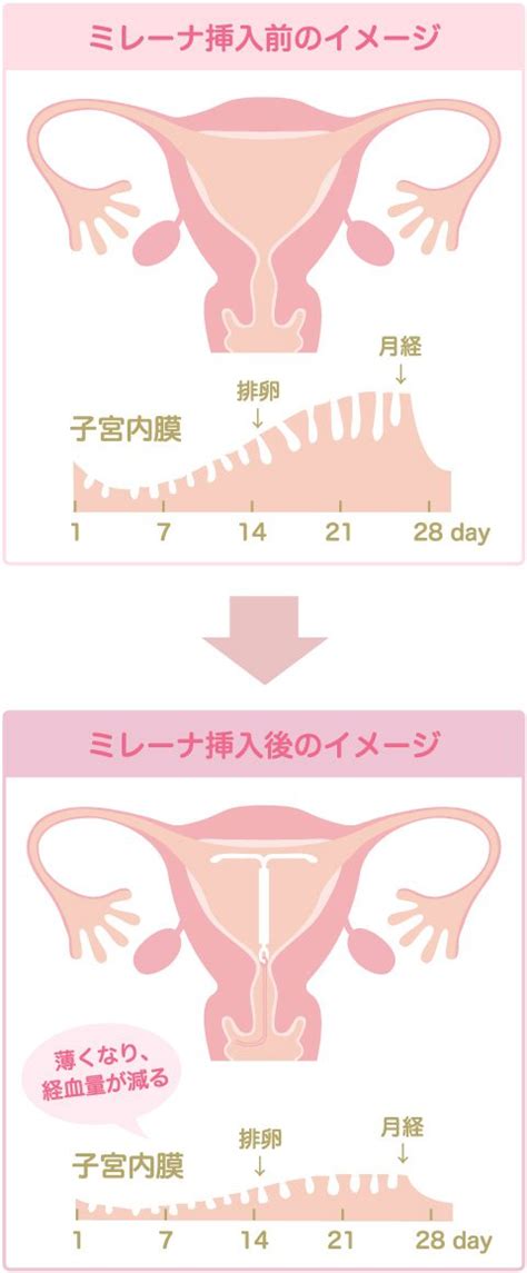 ミレーナ 中だし|ミレーナの効果・副作用・費用｜神戸の中野産婦人